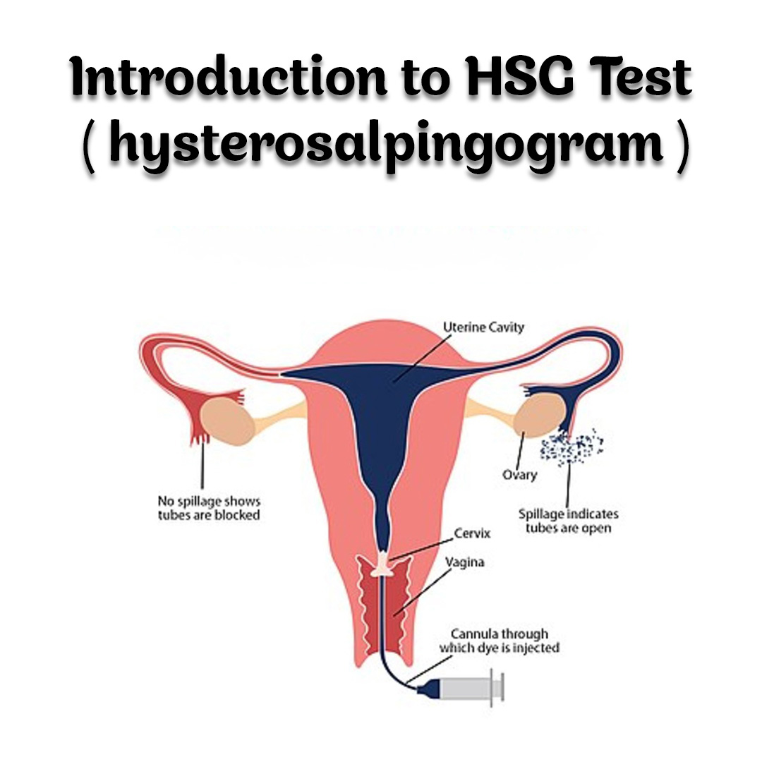 The Procedure of the HSG Test