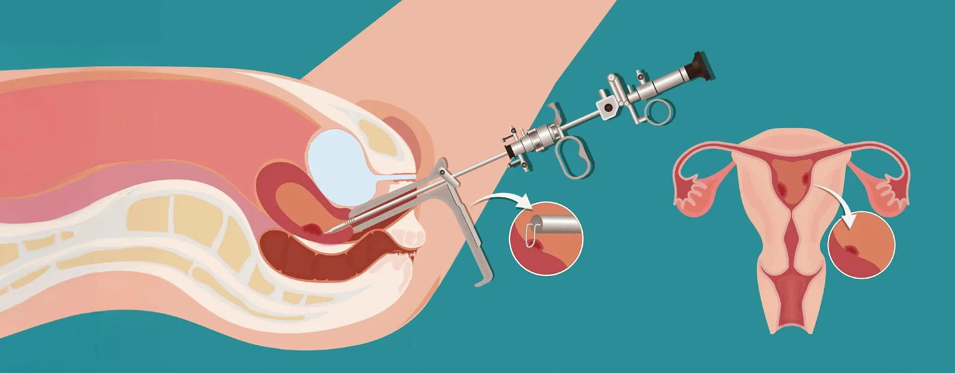 Hyterospery Treatment