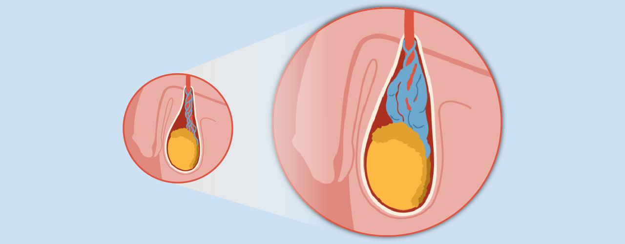 Expert Varicocele Treatment in Bangalore 